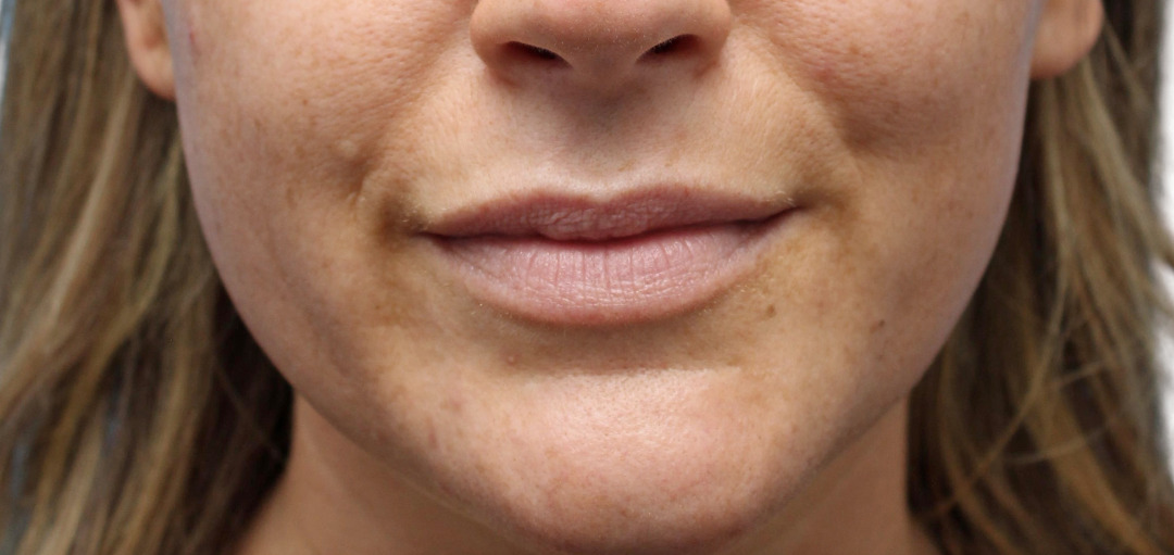 Dermal Fillers in Edina & the Minneapolis Metro Area Metropolitan