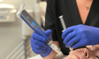 Microneedling Treatment