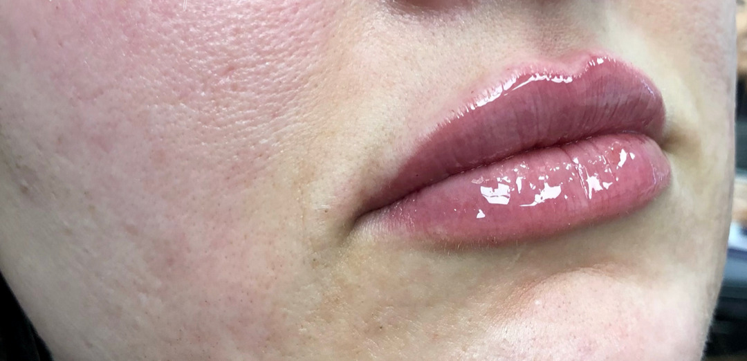 Dermal Fillers in Edina & the Minneapolis Metro Area Metropolitan