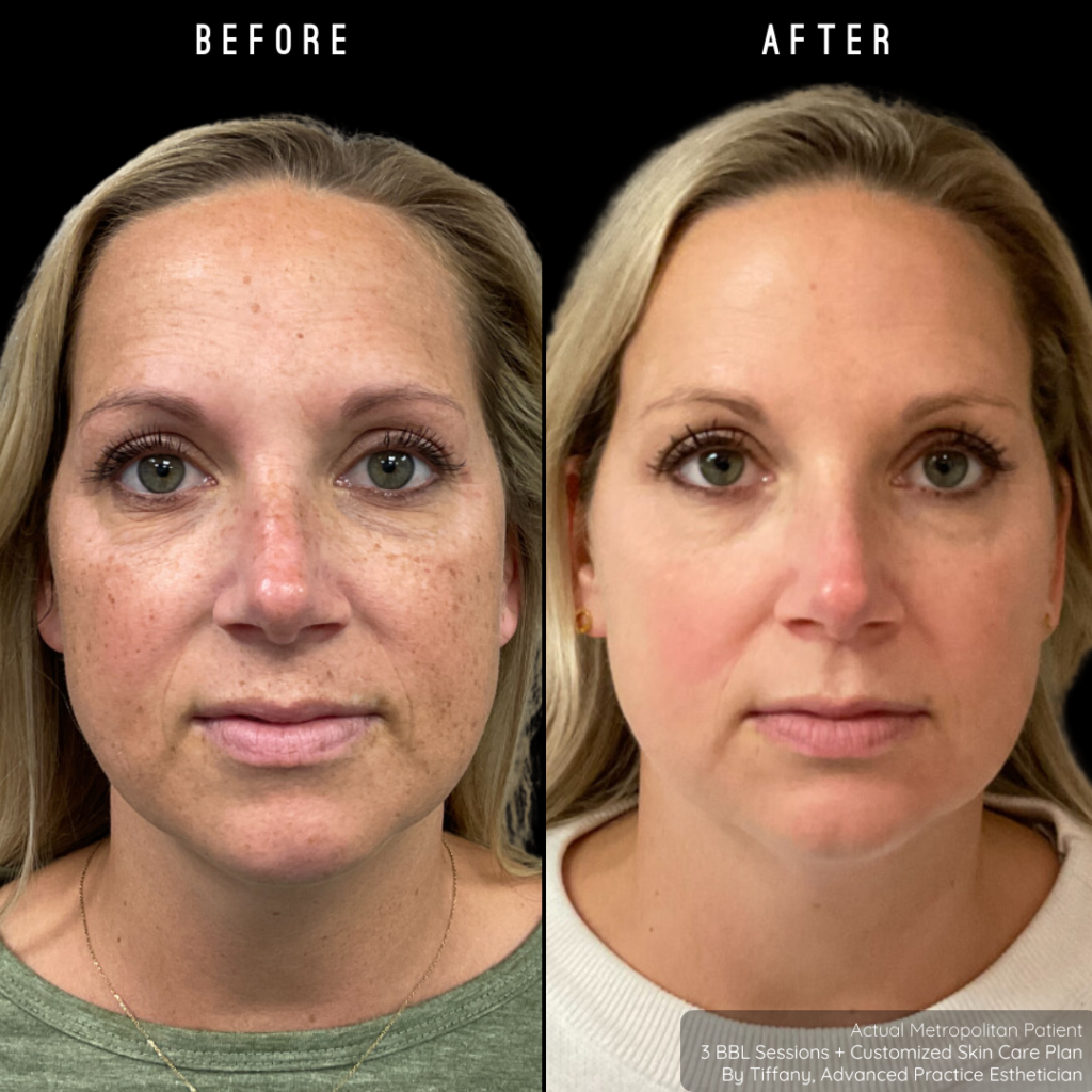 BBL Face/Neck/Chest Maintenance | Buy 3, Get 1 FREE