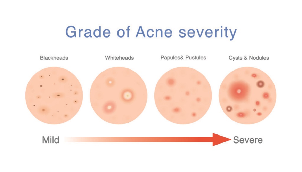 what is acne