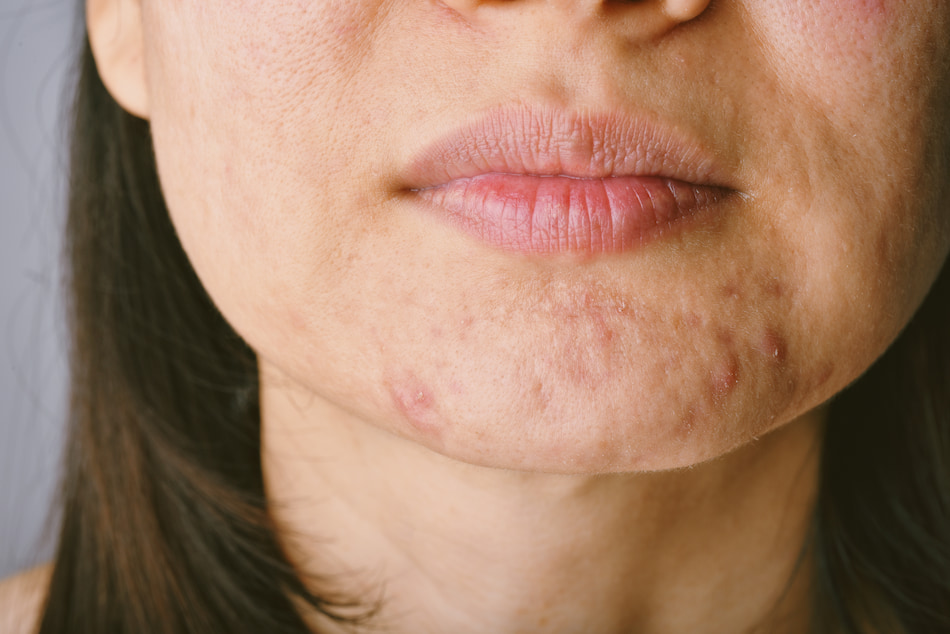 What Are the Causes of Acne?