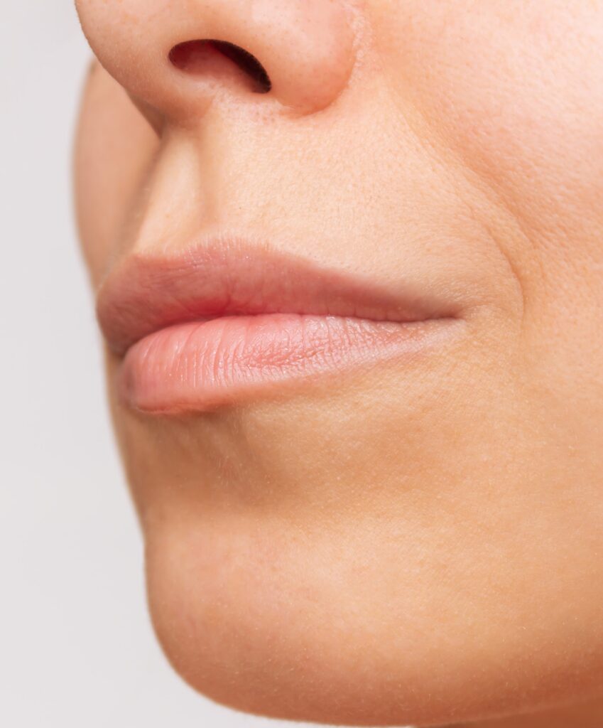 Types of Treatment for Thin Upper Lip
