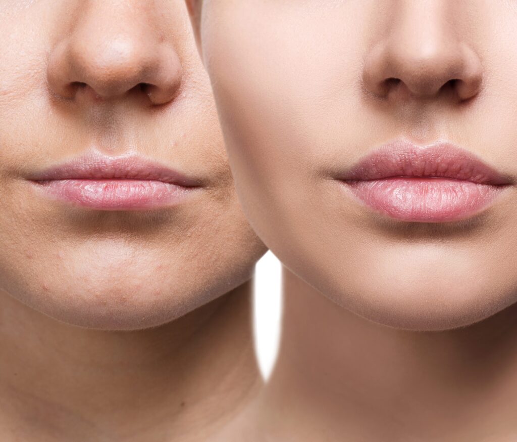 Types of Treatment for Thin Lips