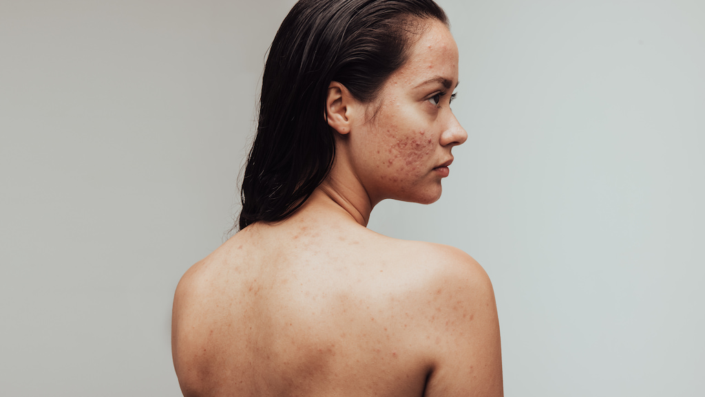 how to get rid of back acne