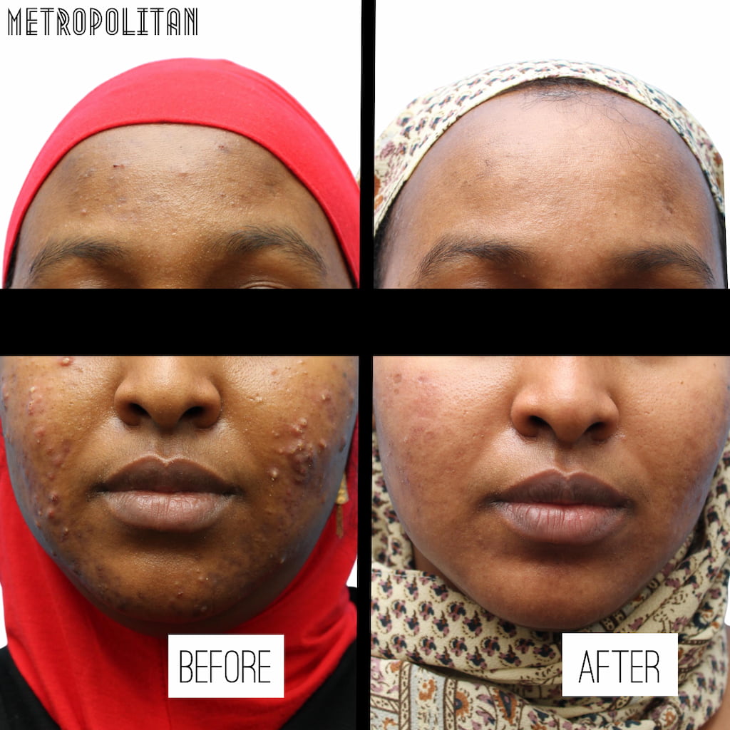 Everything You Need to Know About a Chemical Peel Metropolitan Skin Clinic