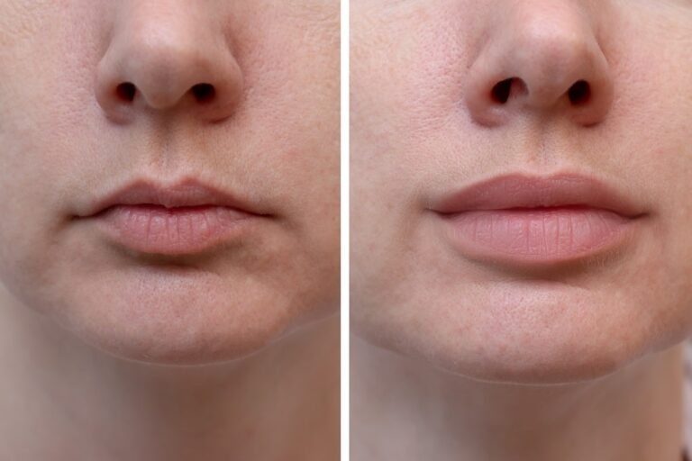 How Much Are Lip Injections and How Long Do Lip Fillers Last?