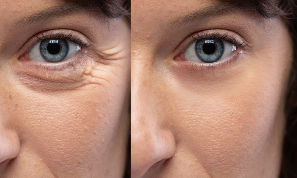 2 Plastic Surgeons on Crow's-Feet, Dark Circles, and Everything about Eyes