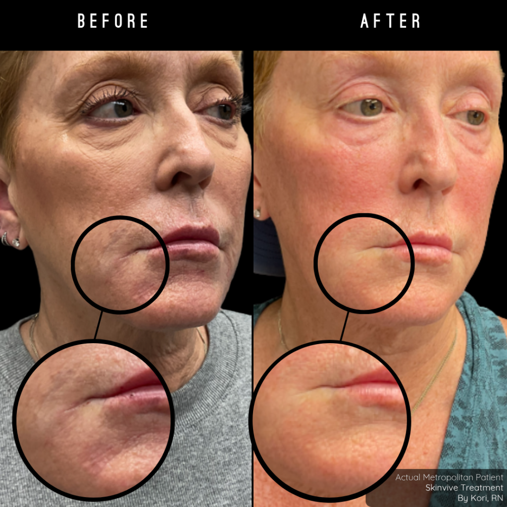 Skinvive | Microdroplet Hyaluronic Acid