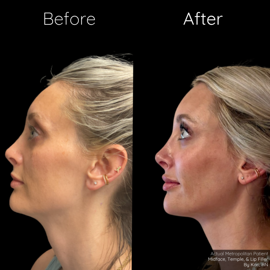 JUVEDERM | $50 off 1st syringe, then $100 off each additional