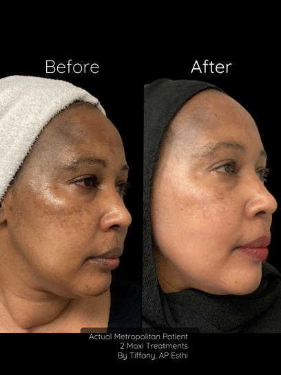 Moxi Skin Treatments | Up to $570 off