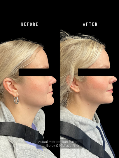 Liqui-Lift | Injectable Combo ($3,510 Value)