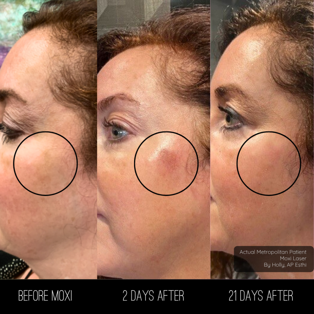 Moxi Skin Treatments | Up to $570 off