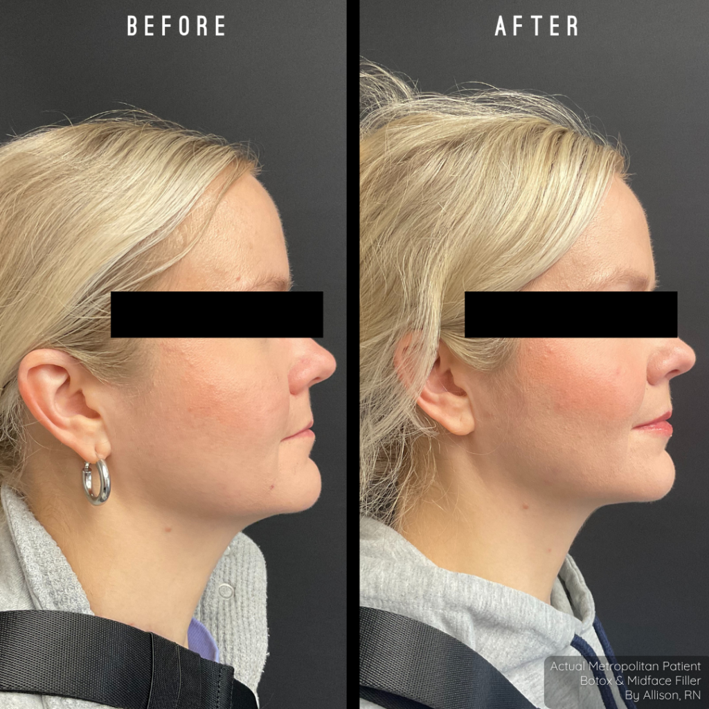 Liqui-Lift | Injectable Combo ($3,510 Value)