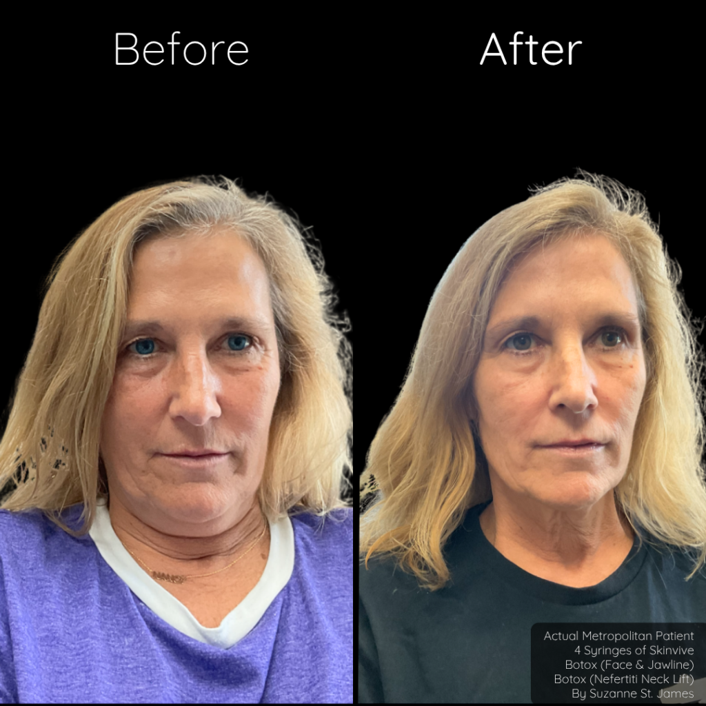 Botox Nefertiti Neck Lift | $10/unit