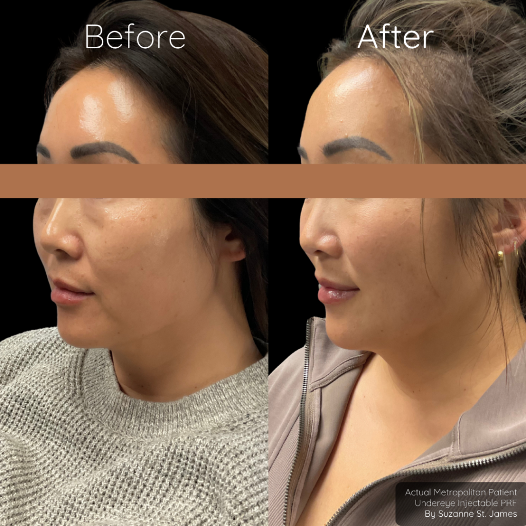 Undereye Rejuvenation Pkg | Price $2300 (value $2508)