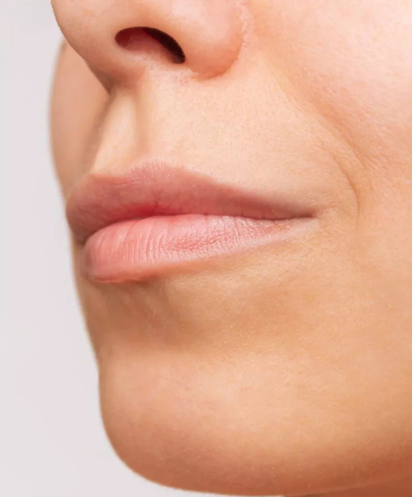 Types of Treatment for Thin Upper Lip