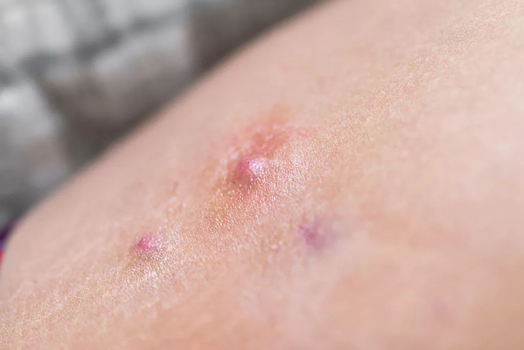chemical peel for body acne