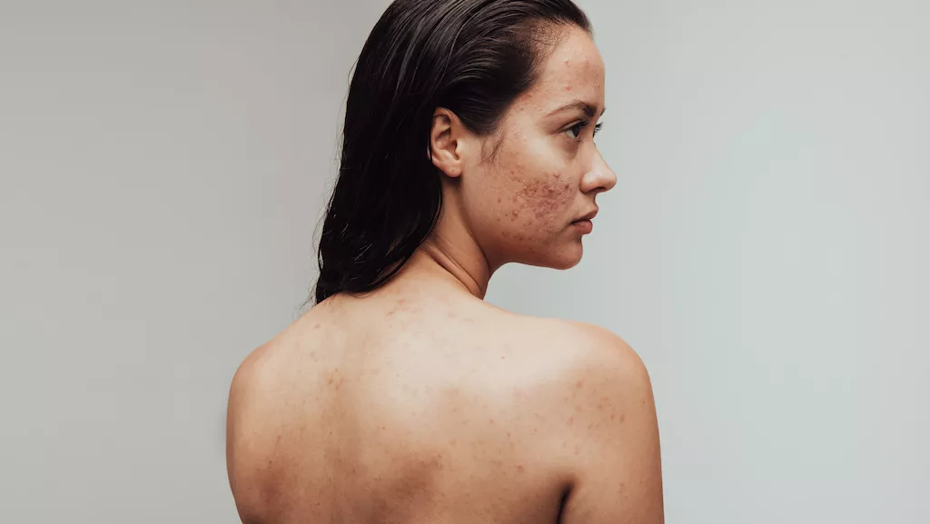 how to stop chest acne