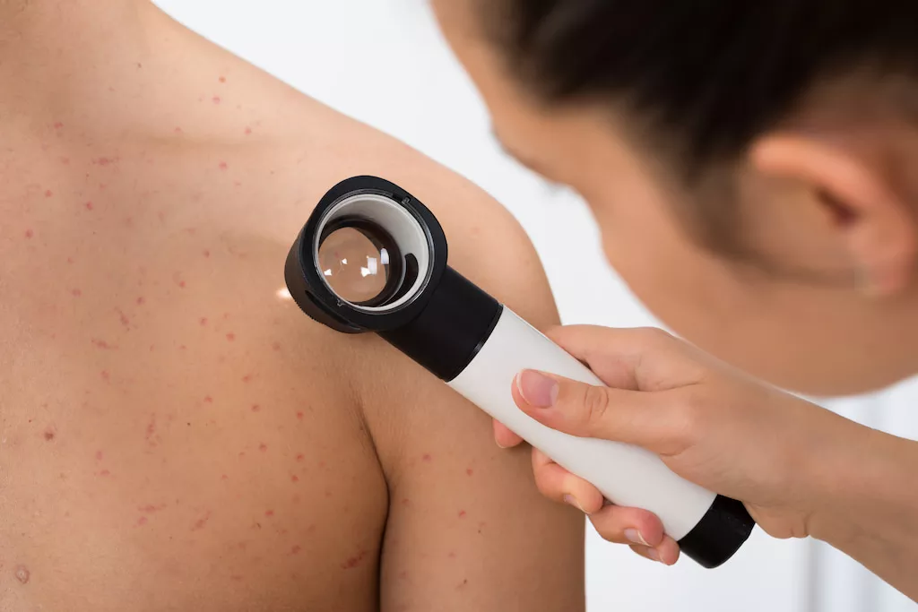 body acne causes