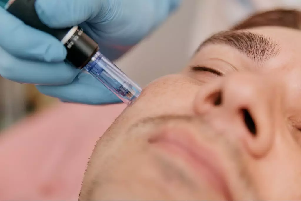 microneedling with prp vs without