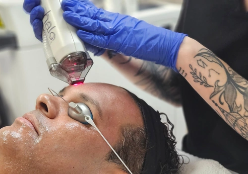 Laser Treatments